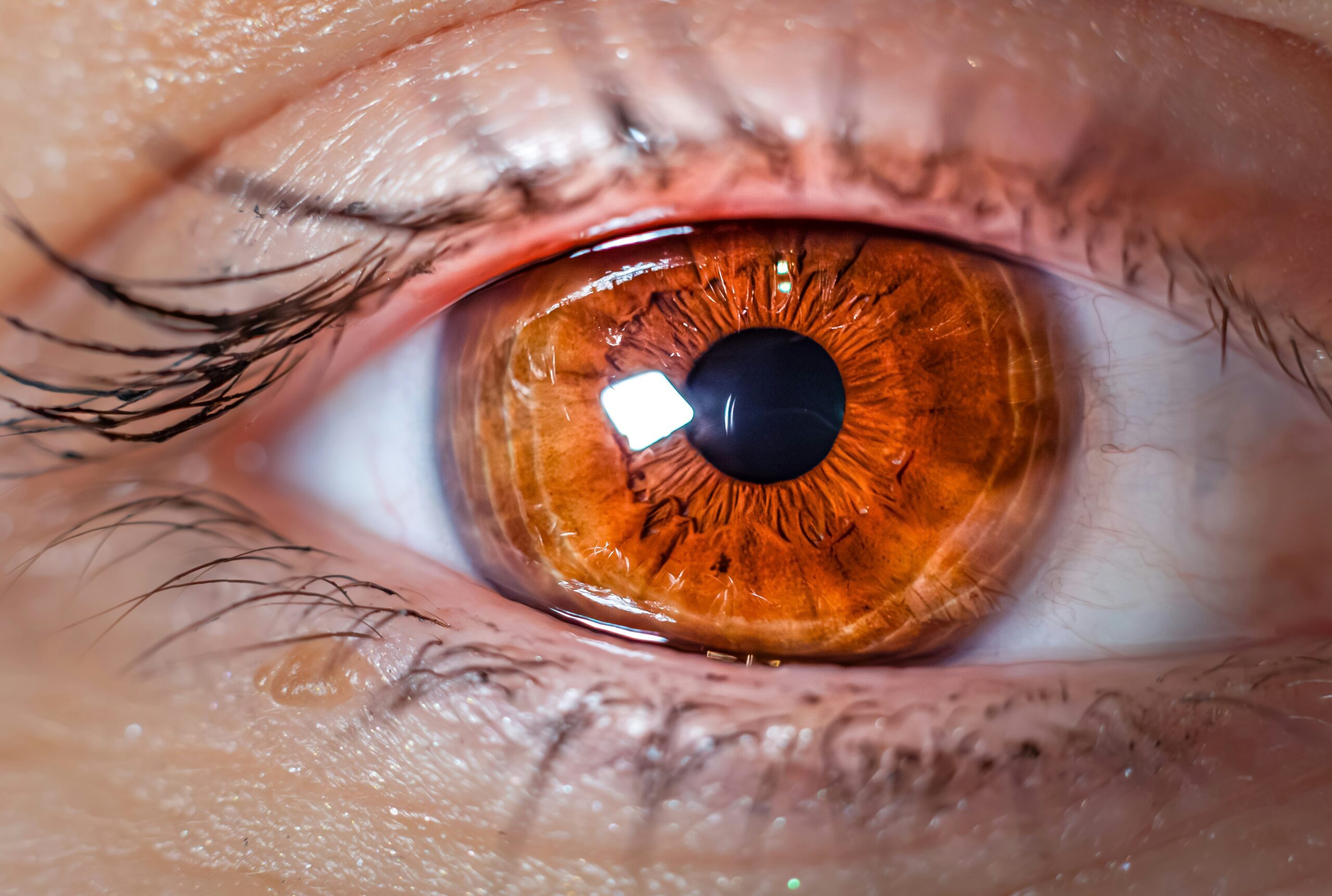 Refractive Cataract Surgery